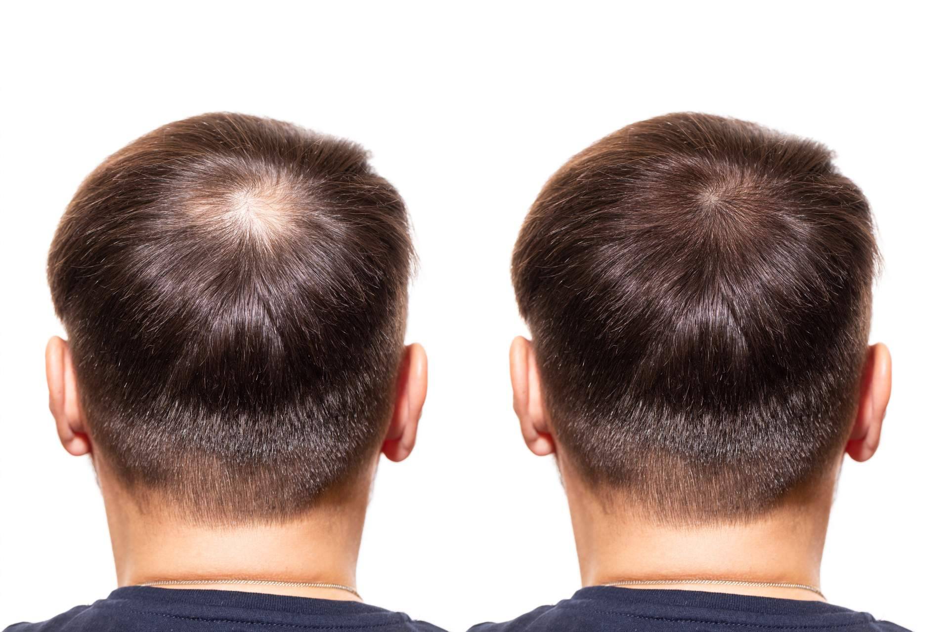DERMO SUMAK – MINOXIDIL PREMIUM 5MG– 60 CÁPSULAS