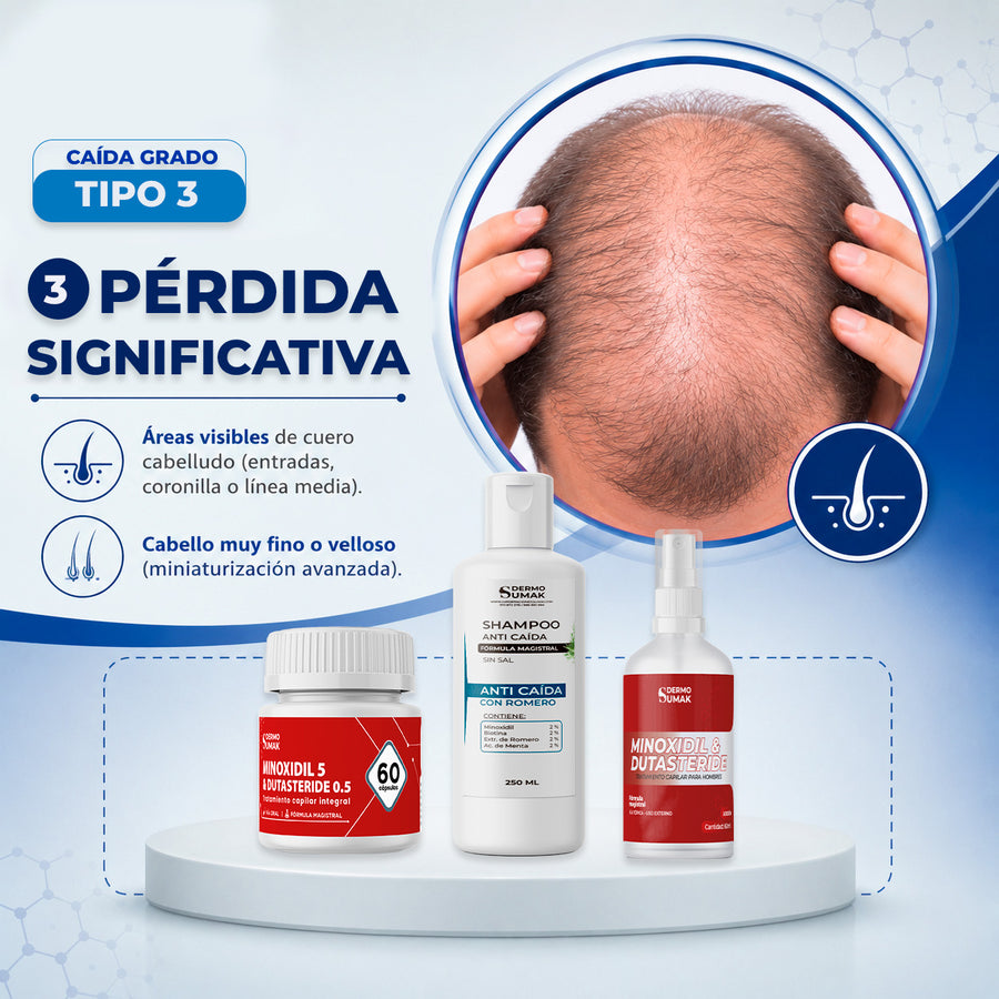 PÉRDIDA SIGNIFICATIVA