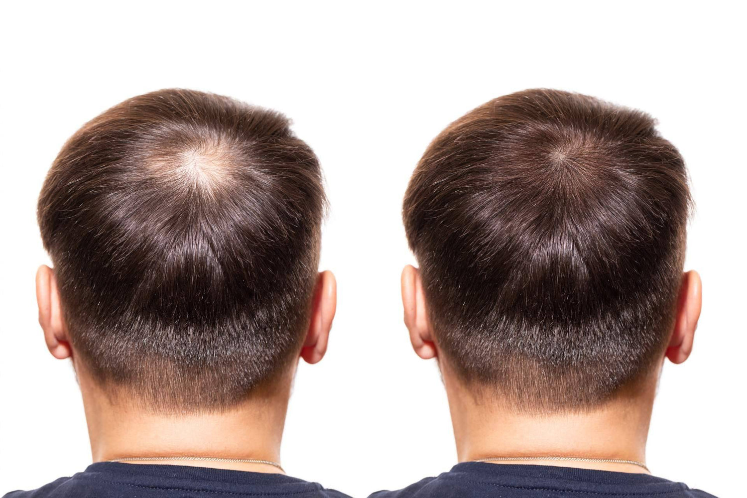 DERMO SUMAK – MINOXIDIL PREMIUM 5MG– 60 CÁPSULAS